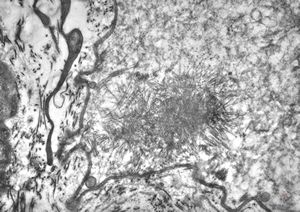 F,25y. | myopathy - atrophic and regenerating muscle cells